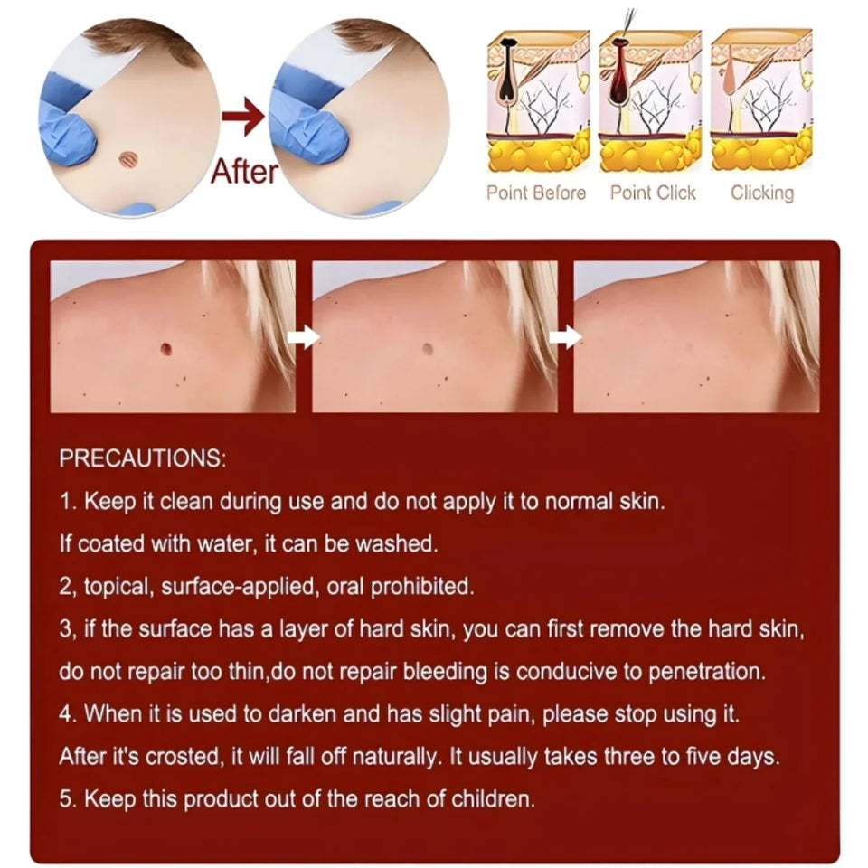 Advanced Moles, Tags & Spot Remover Gel  (BUY 1 GET 1 FREE)
