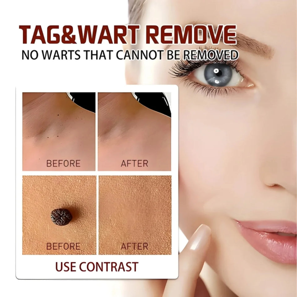 Advanced Moles, Tags & Spot Remover Gel  (BUY 1 GET 1 FREE)
